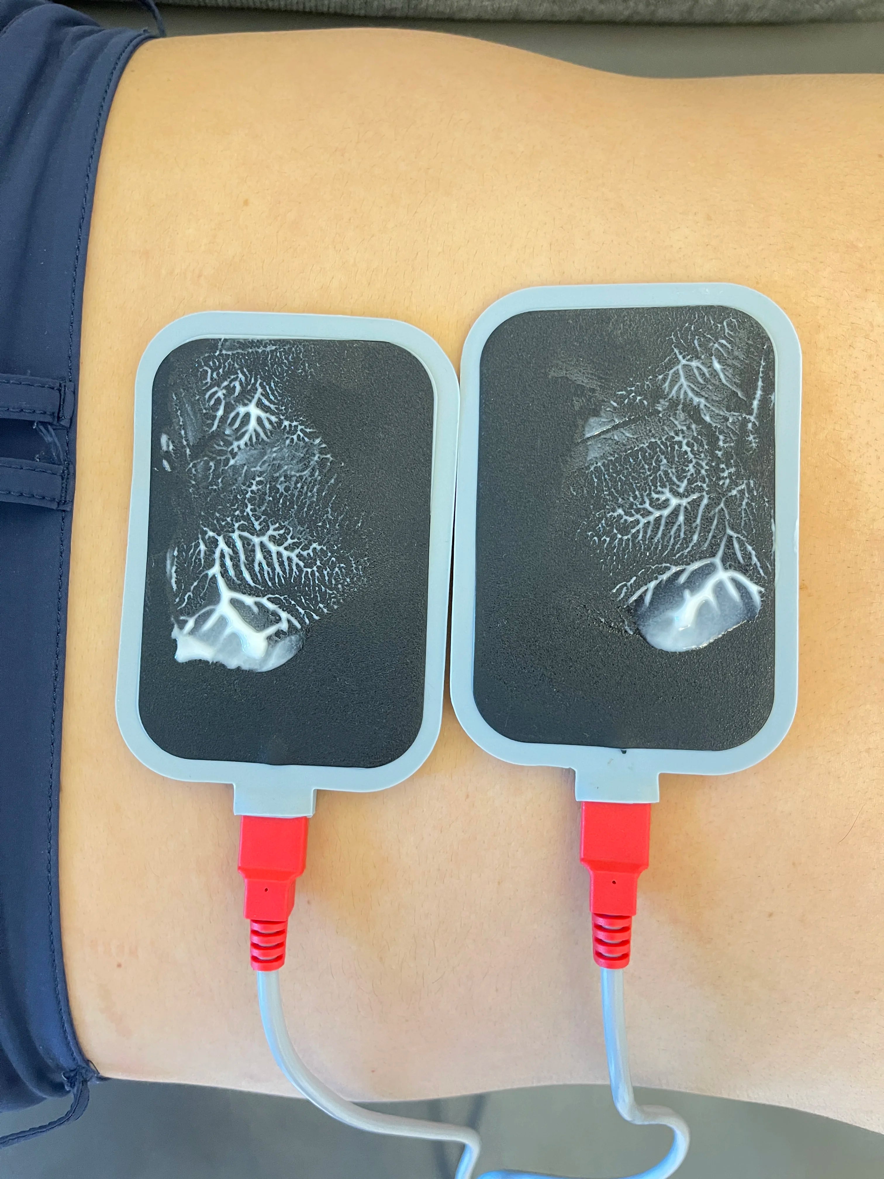 Two black DDS bio-electric therapy electrode pads with conductive gel applied to skin for home body massage treatment.