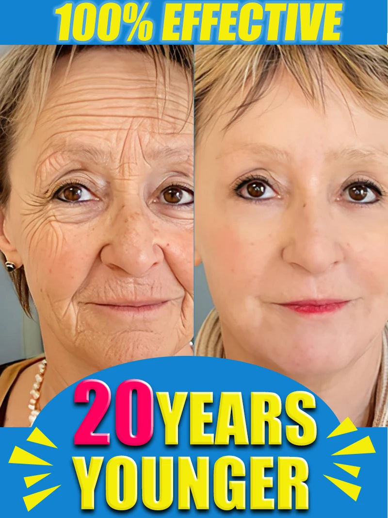 Before and after comparison of a woman's face, showing significantly reduced wrinkles after using Wrinkle Disappear.