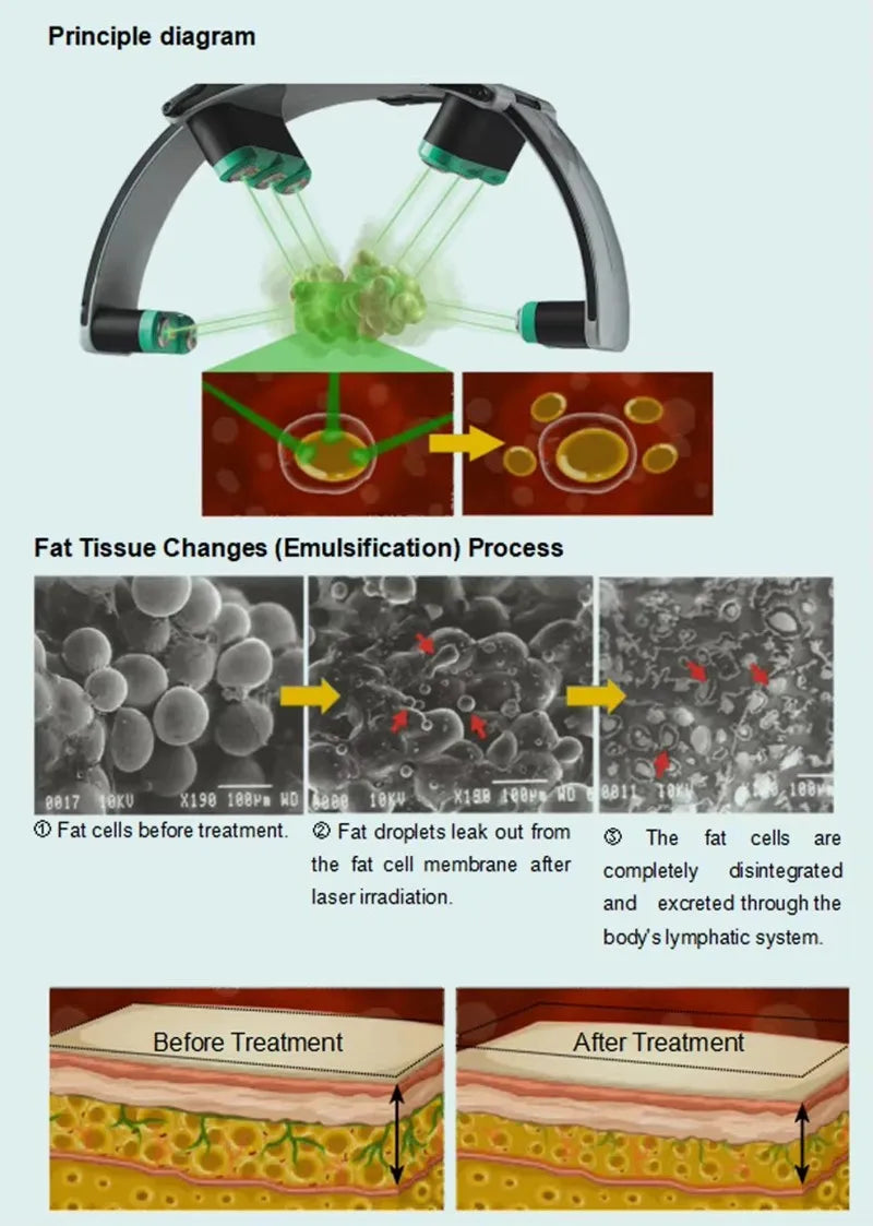 LLLT laser fat removal device showing LLLT light therapy principle, cell emulsification, and before-after skin diagrams.