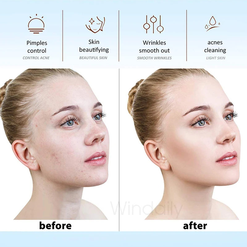 Before and after comparison of a woman's face showing skin improvement from high-frequency facial therapy.