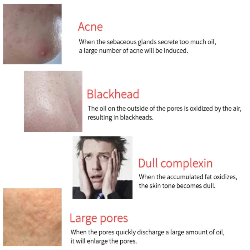Infographic showing skin issues: acne, blackheads, dull complexion, and large pores with descriptive text.
