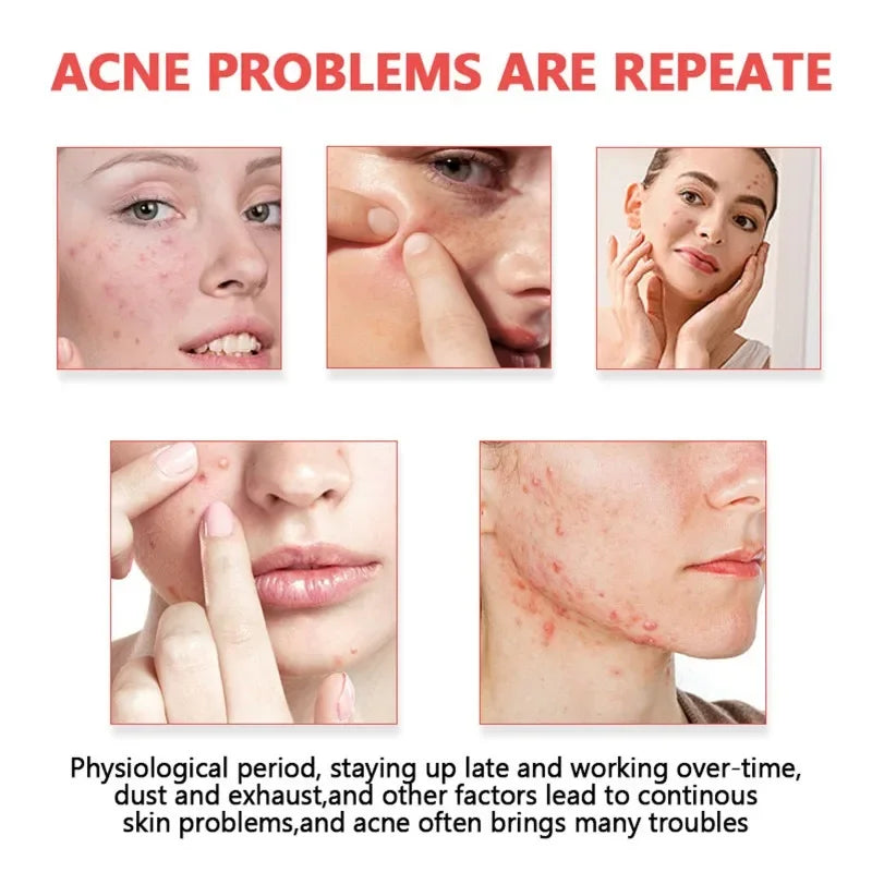 200/400pcs Acne Patches Invisible Pimple Cover for Face Oil Control Spot Treatment Cute Sticker for Covering Zits and Blemishes
