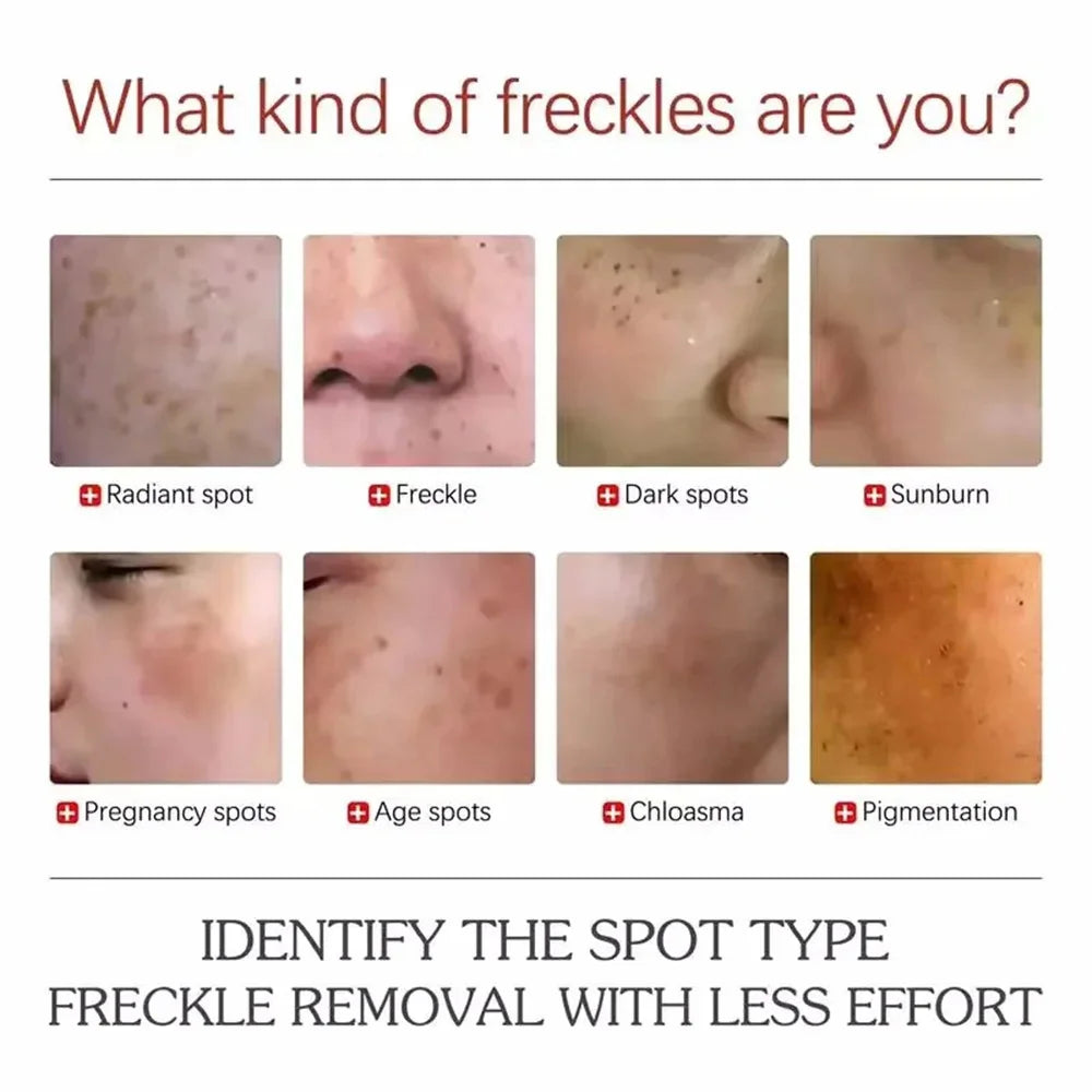 Infographic showing eight types of skin spots: radiant, freckle, dark, sunburn, pregnancy, age, chloasma, pigmentation.