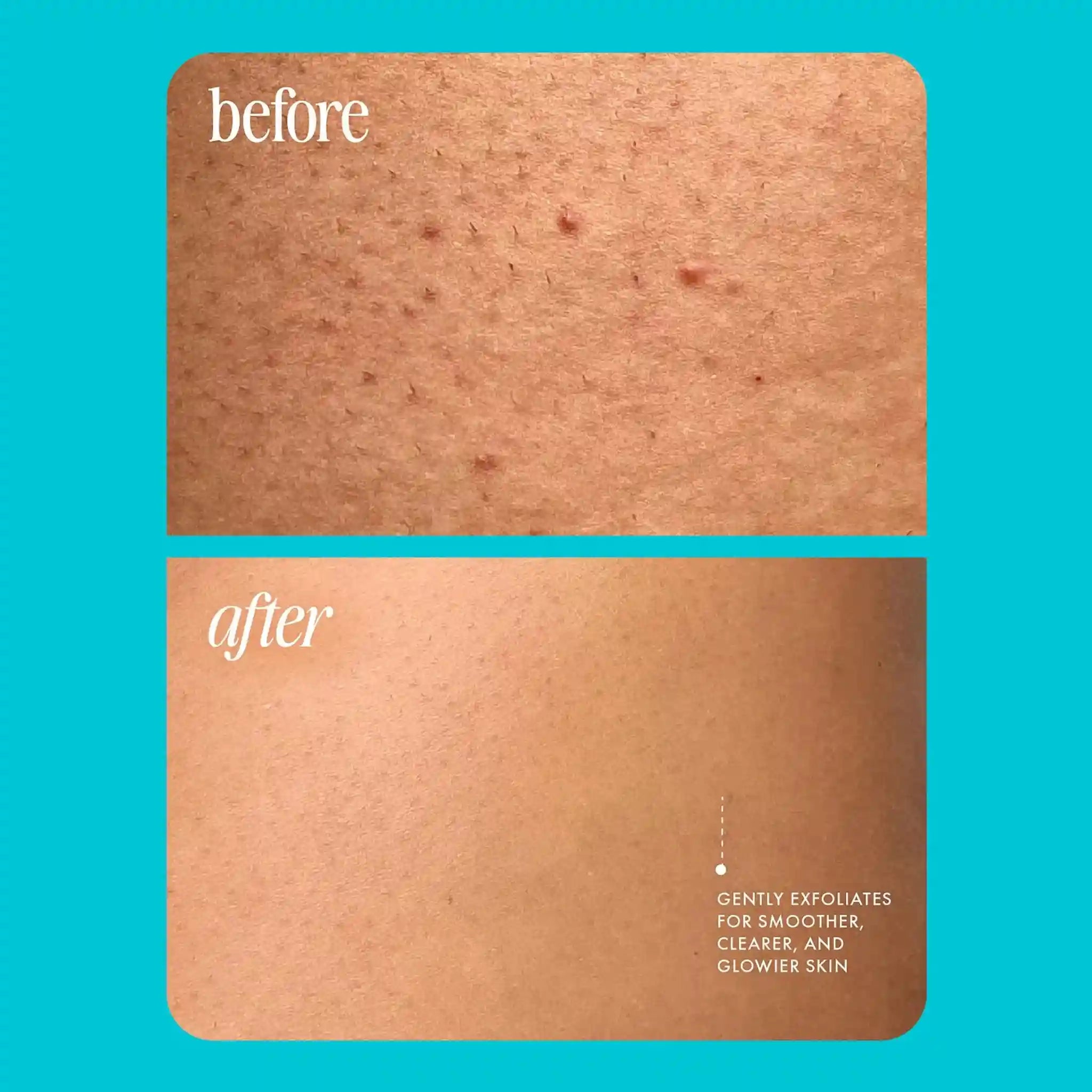 Bikini Area Exfoliator Scrub - Natural Ingrown Hair Treatment (GZE241) Scrubs Treatments Tidesmit