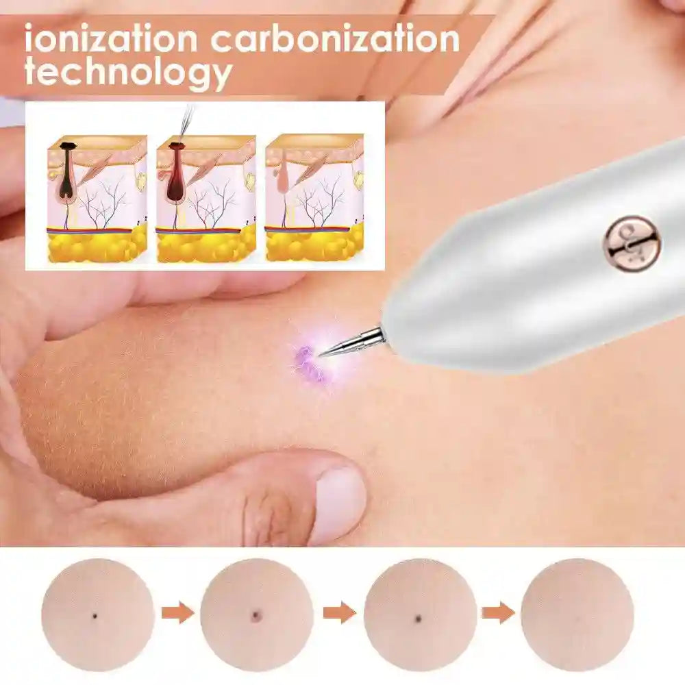 Handheld white ion carbonization pen for tattoo, mole, and spot removal with plasma treatment technology.