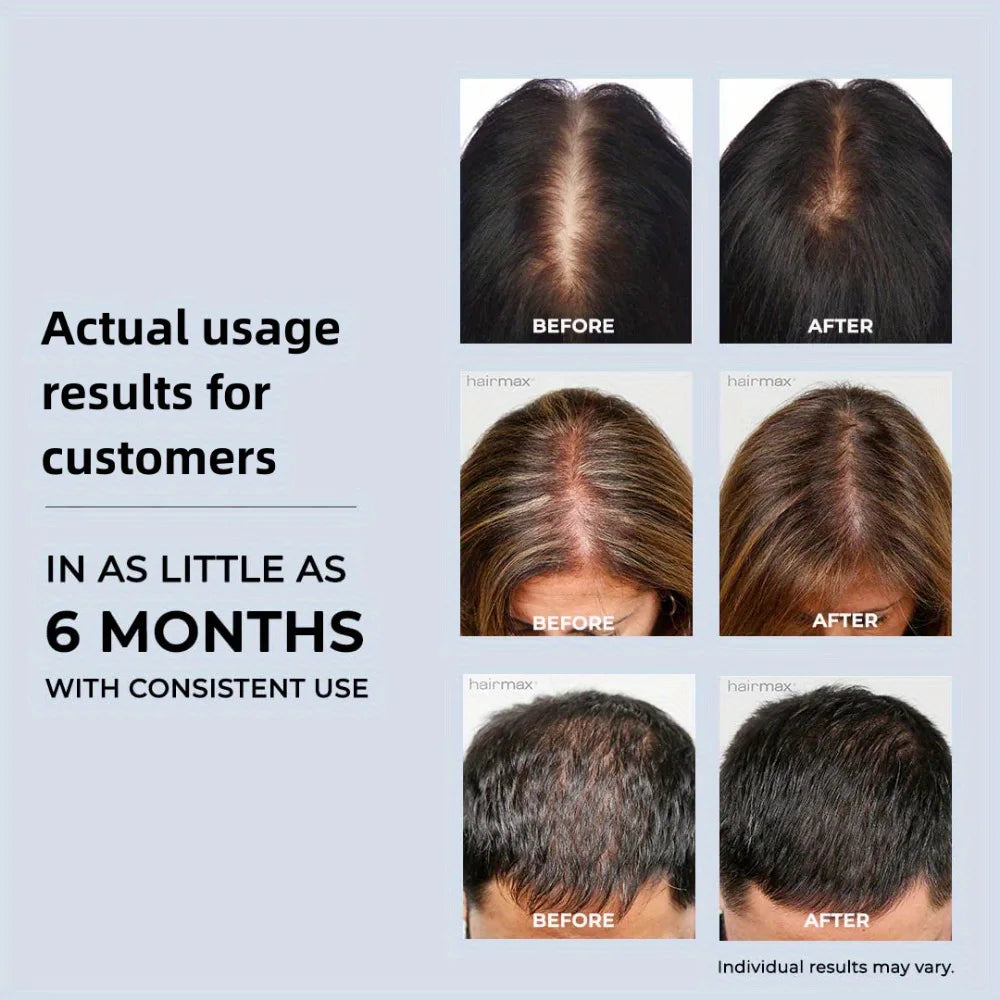 Before and after hair growth results using LED red light therapy cap for hair loss treatment and scalp health.