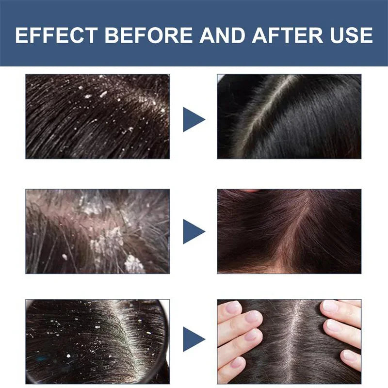 Anti Dandruff Scalp Scrub Treatment for Itch Relief - Tidesmit Scrubs Treatments Tidesmit