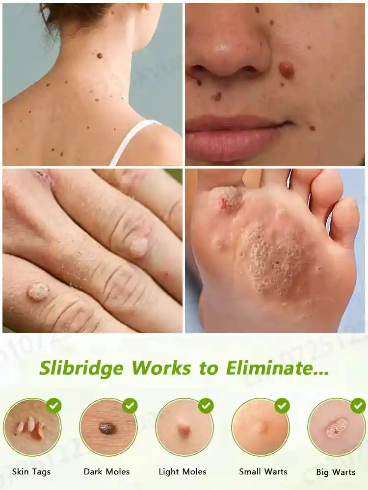 Wart Remover Treatment - Professional Skin Tag Repair Kit (1-2pc) Relaxation Treatment Tidesmit