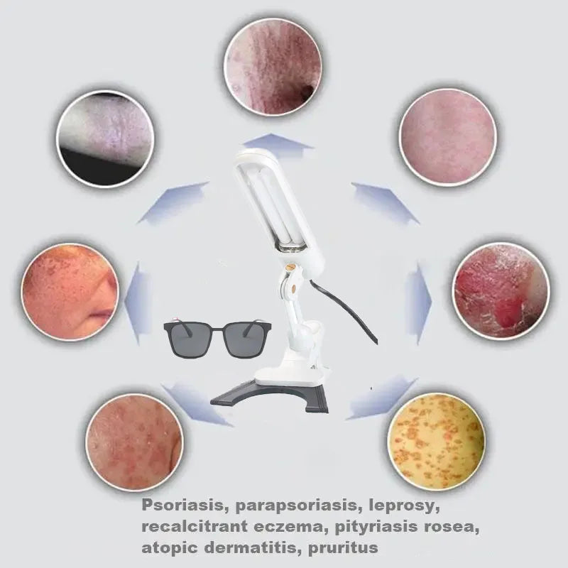 Portable 311nm UVB light therapy lamp for treating vitiligo, psoriasis, and eczema with protective glasses.