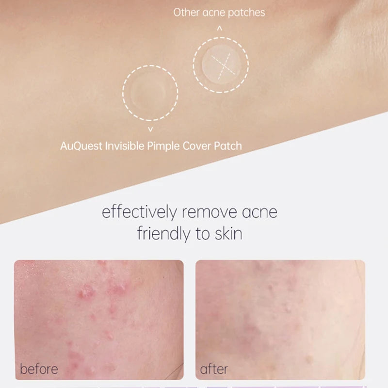 36pcs Hydrocolloid Acne Patches Absorb Pus & Oil, Reduce Redness, Invisible Fit for All-Day Wear Spot Stickers for Face and Body