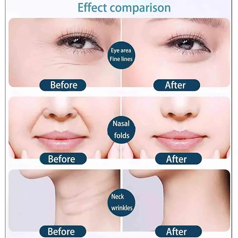 Before-and-after comparison showing reduced eye fine lines, nasal folds, and neck wrinkles on skin.