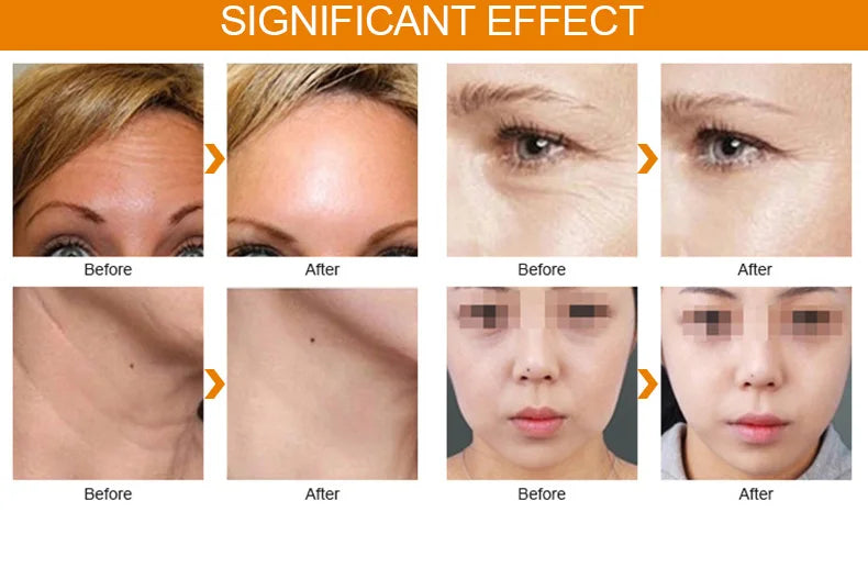 Before and after results of 576 points Liposonic portable body tightening and facial anti-aging slimming machine.