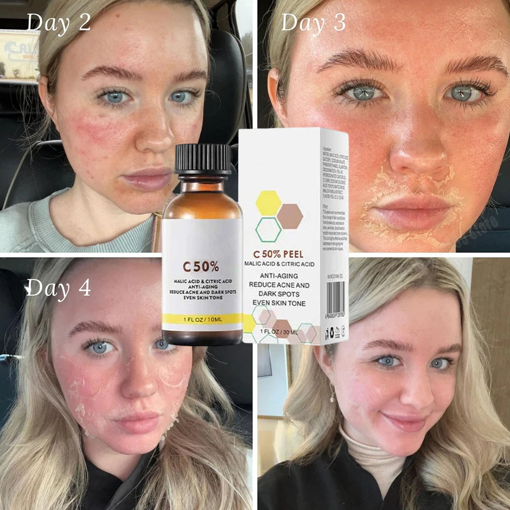 Salicylic Acid Face Peel - Professional Deep Exfoliation & Skin Refinement Scrubs Treatments Tidesmit