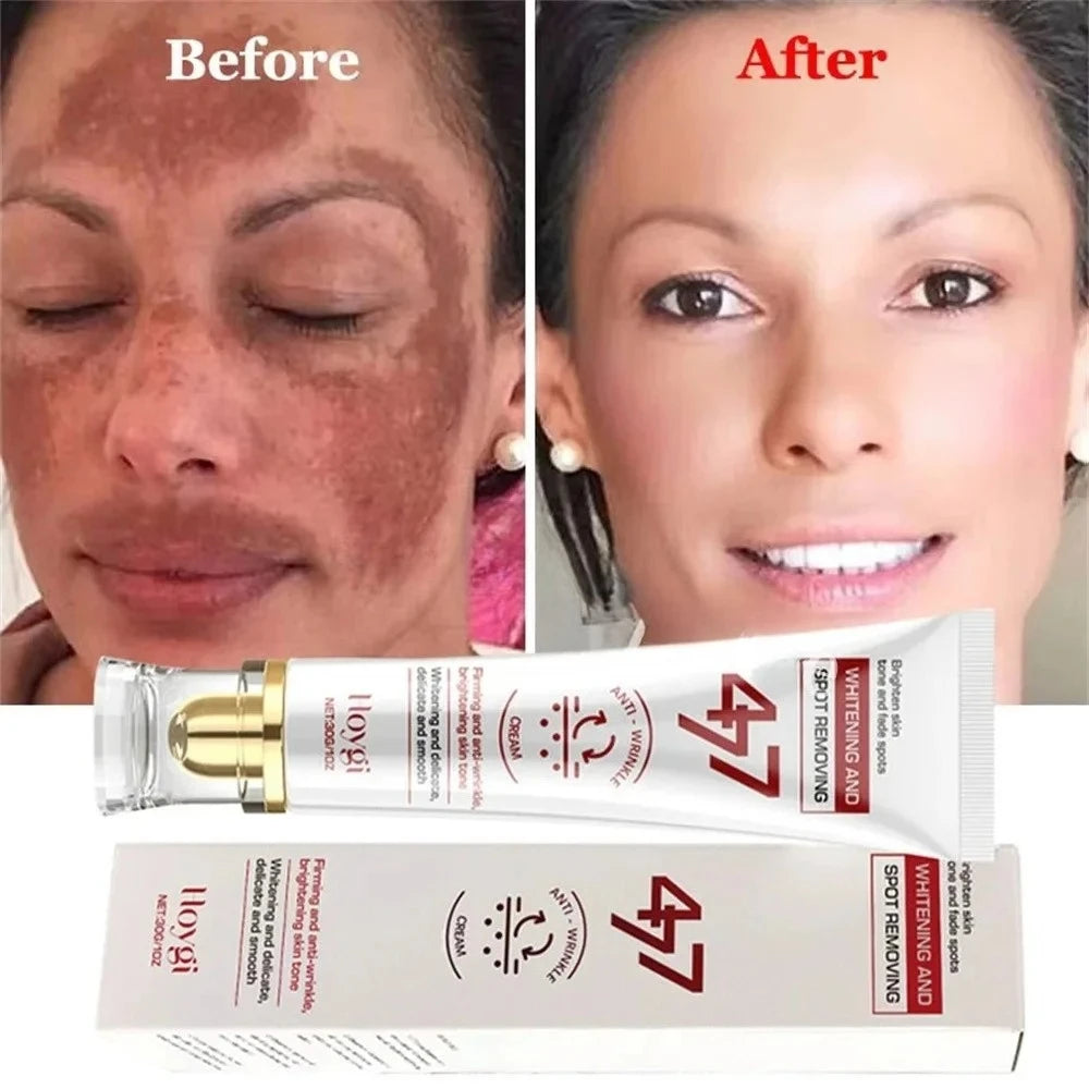 Hoygi 477 white tube cream for face, shown with a before-and-after comparison of skin spot fading.