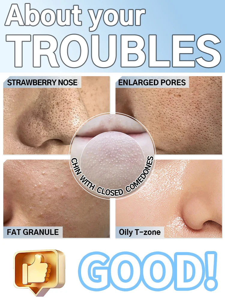 Collage showing common skin concerns: blackheads on nose, enlarged pores, fat granules, and oily T-zone.