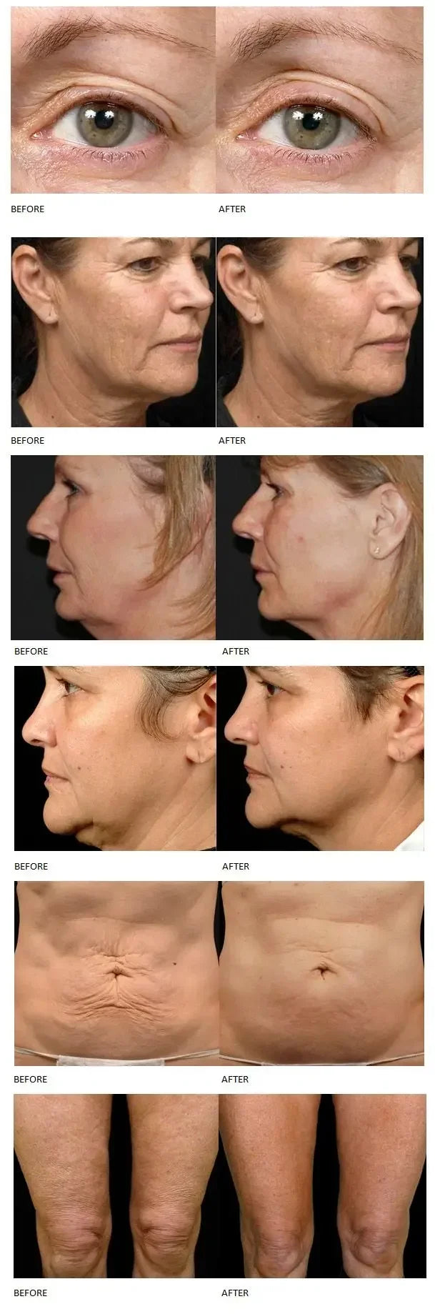 Before and after results of Ultra 360 body contouring, anti-aging, and skin tightening machine for face and body.