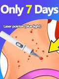 Wart Removal Blue Light Lamp 22PCS - Portable Foot Care Tool Massage Roller 5PCS Tidesmit