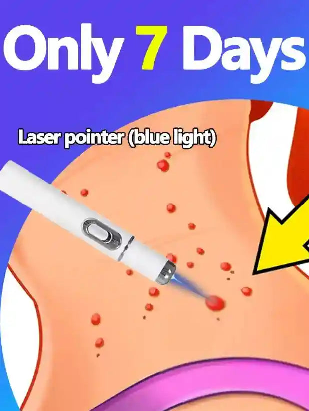 Wart Removal Blue Light Lamp 22PCS - Portable Foot Care Tool Massage Roller 5PCS Tidesmit