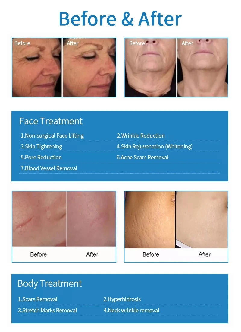 Before and after results of portable fractional RF skin tightening device for facial, body, wrinkle, and scar removal.