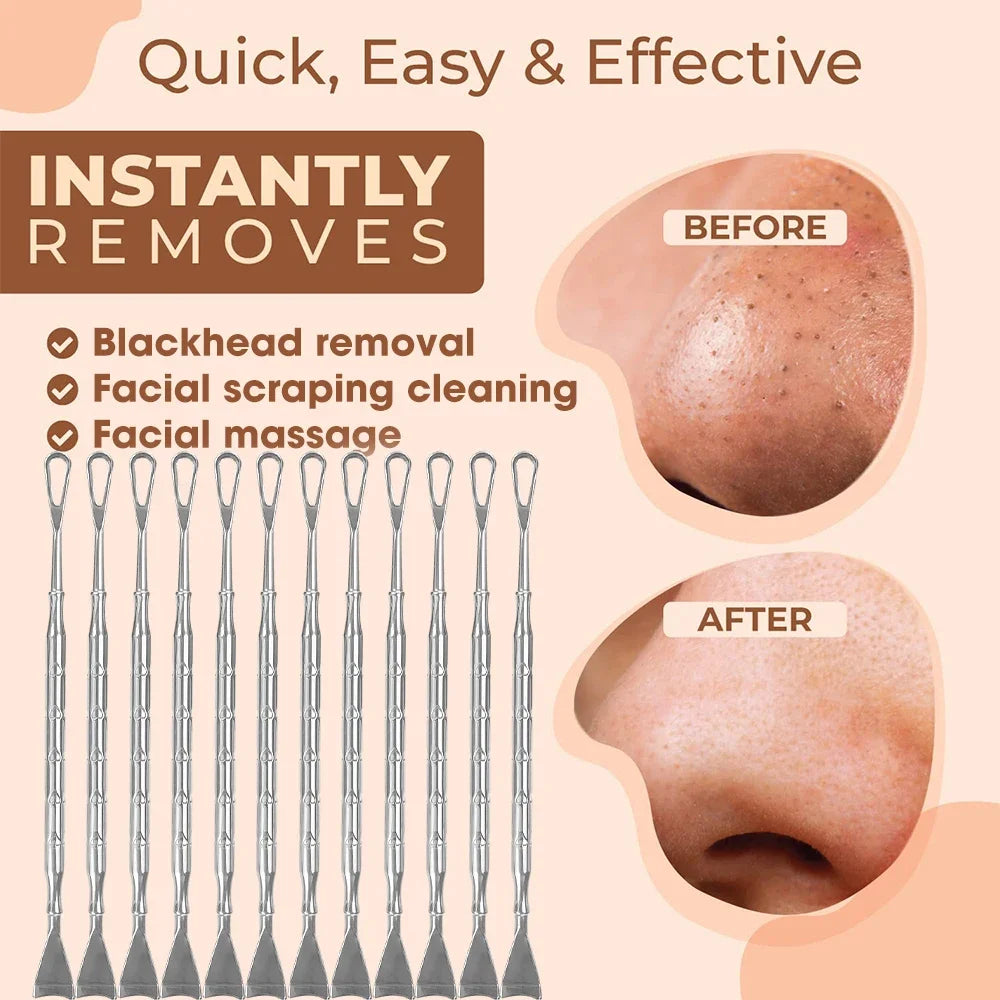 Blackhead Remover Tool Kit 4pc - Professional Stainless Steel Acne Set Scrubs Treatments Tidesmit