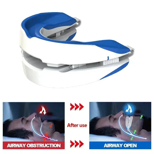 Blue and white mandibular advancement device for sleep apnea treatment to keep airways open while sleeping.