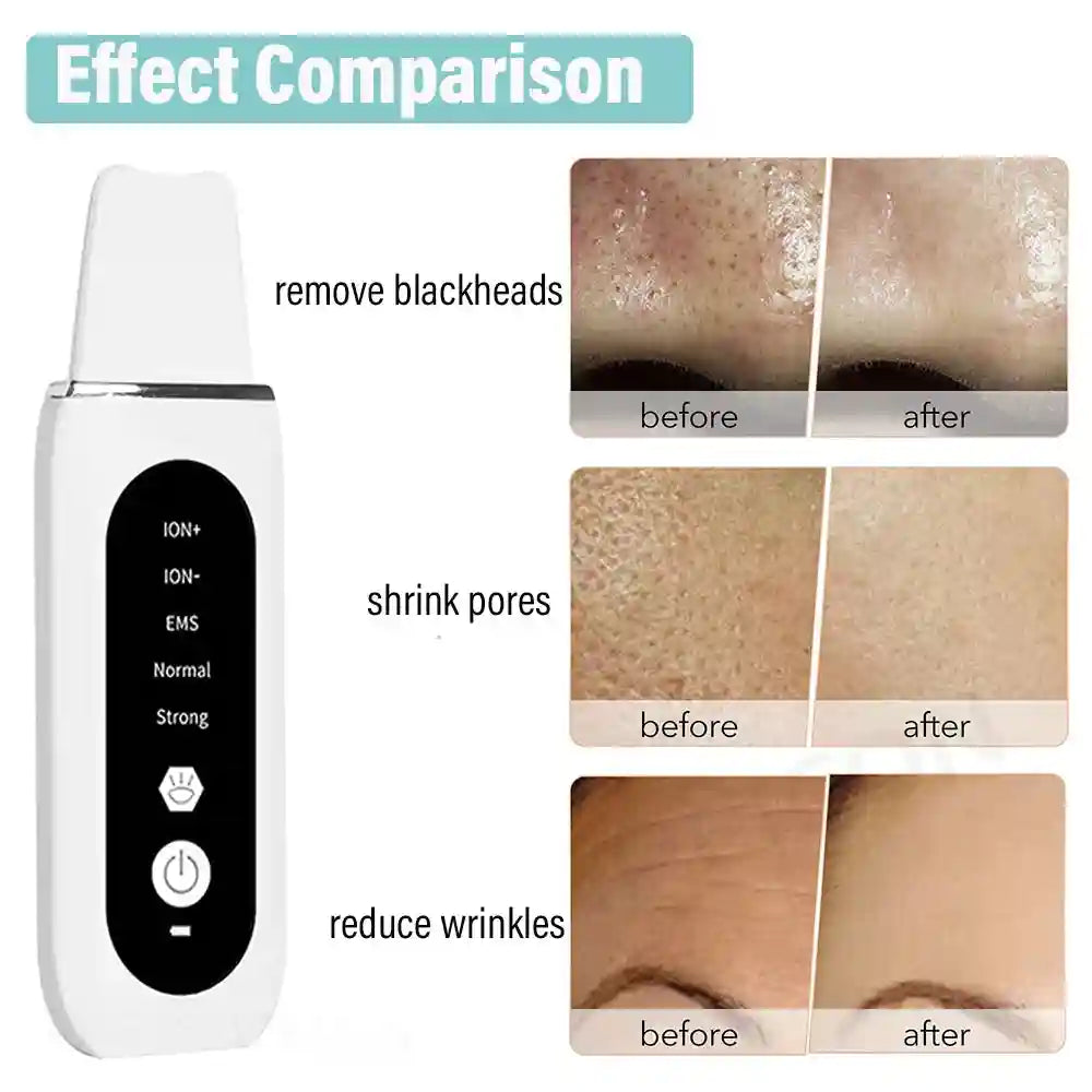 Ultrasonic Skin Scrubber | Professional Facial Cleansing Tool Scrubs Treatments Tidesmit
