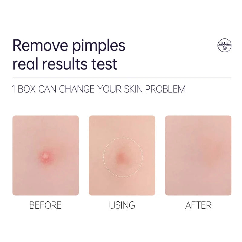 36pcs Hydrocolloid Acne Patches Absorb Pus & Oil, Reduce Redness, Invisible Fit for All-Day Wear Spot Stickers for Face and Body