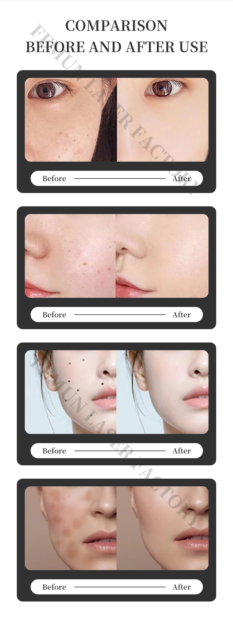 Before and after results using portable 4000W picosecond Nd:YAG laser for skin rejuvenation and tattoo removal.