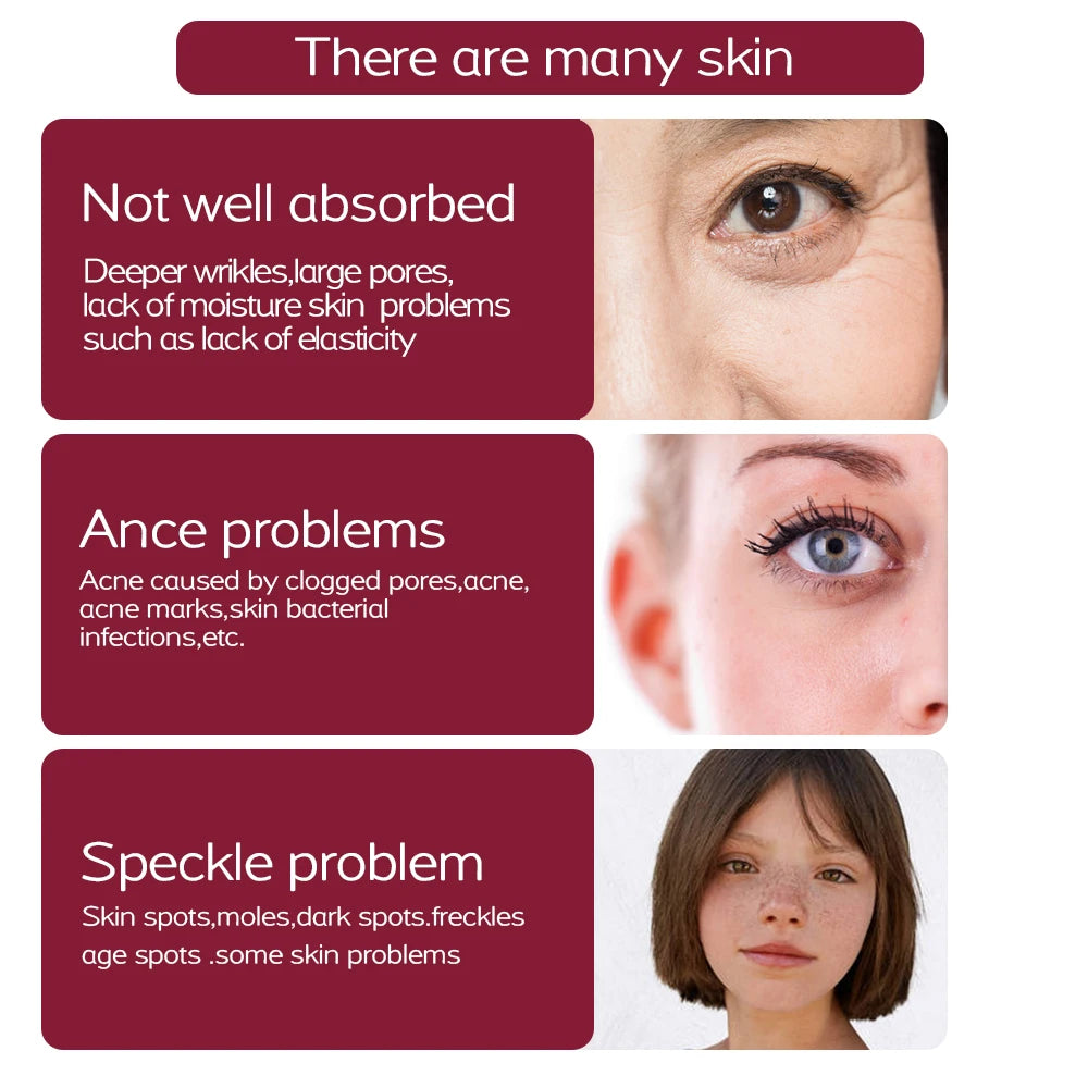Plasma skin pen for removing moles, dark spots, freckles, and acne, showcasing skin treatment benefits for face care.