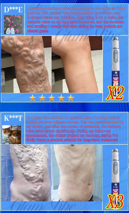 Varicose vein treatment pen. A slender, silver handheld device used to reduce the appearance of leg veins.
