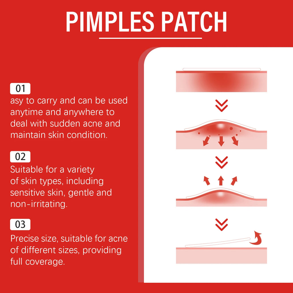 Salicylic Acid Acne Patches 240 Pcs – Shape Assorted Skin Care Scrubs Treatments Tidesmit