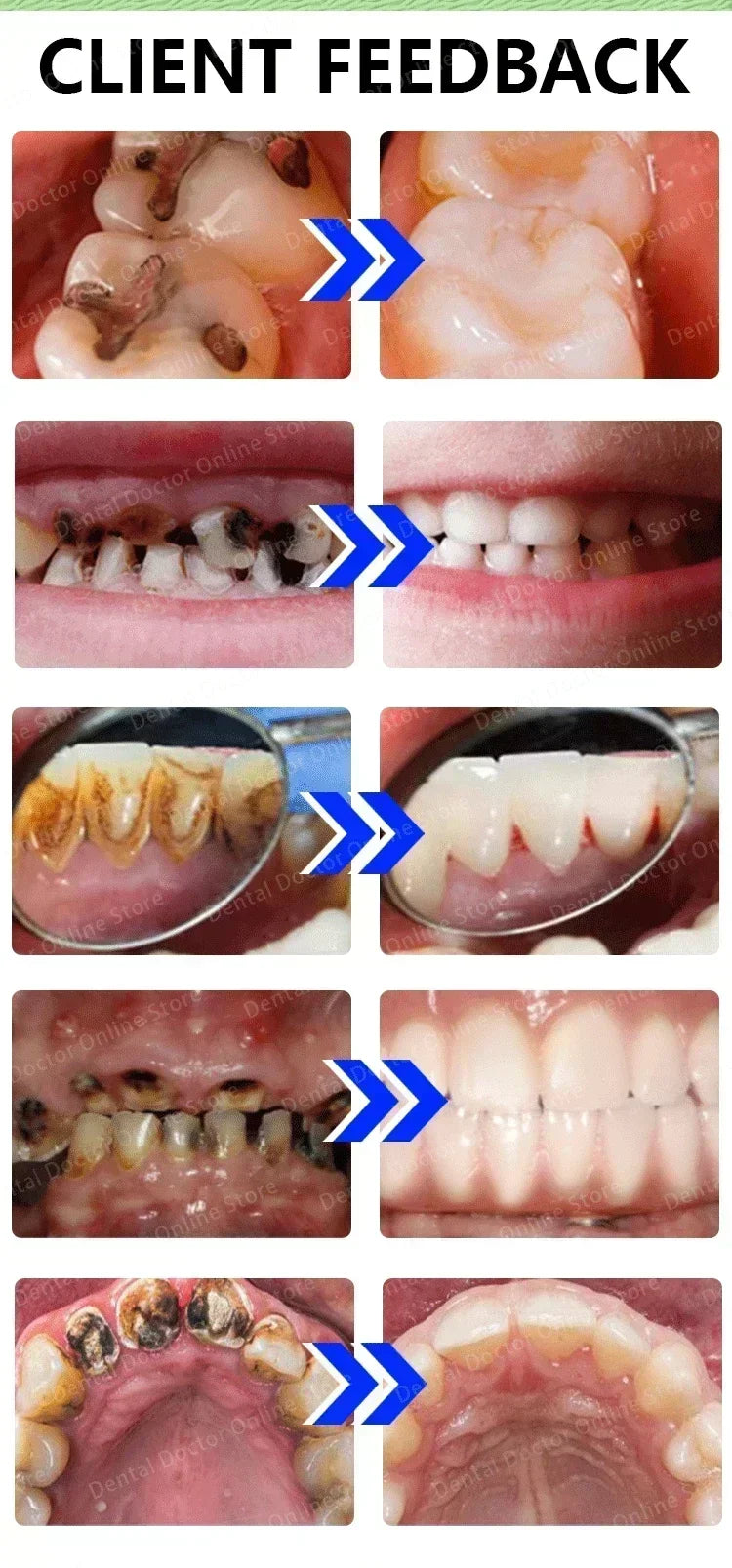 Tidesmit teeth whitening and tooth decay repair treatment for cavity protection and plaque stain removal