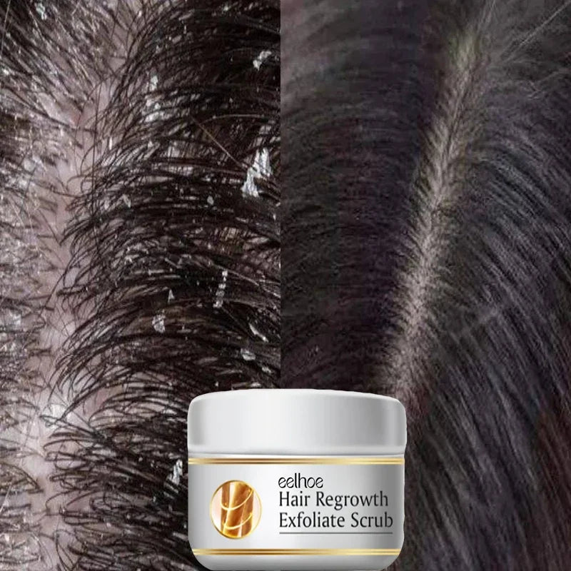 Anti Dandruff Scalp Scrub Treatment for Itch Relief - Tidesmit Scrubs Treatments Tidesmit