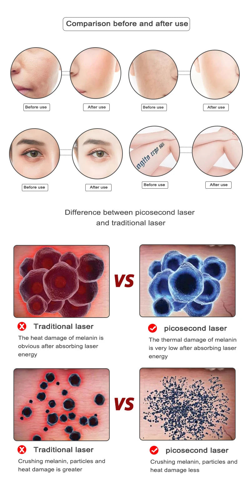 Picosecond Laser Pen for Dark Spot Removal - Portable PMU Machine Permanent Makeup Machines Tidesmit