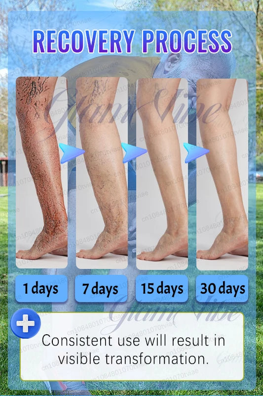 Four photos showing the 30-day fading of visible spider veins on a person's lower leg to demonstrate treatment progress.