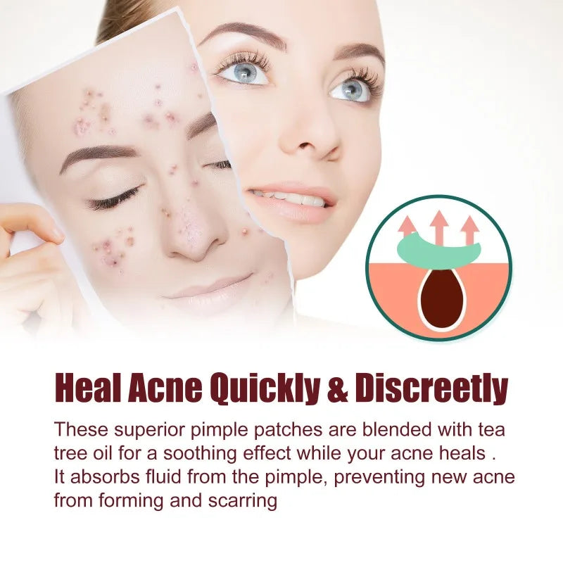 200/400pcs Acne Patches Invisible Pimple Cover for Face Oil Control Spot Treatment Cute Sticker for Covering Zits and Blemishes