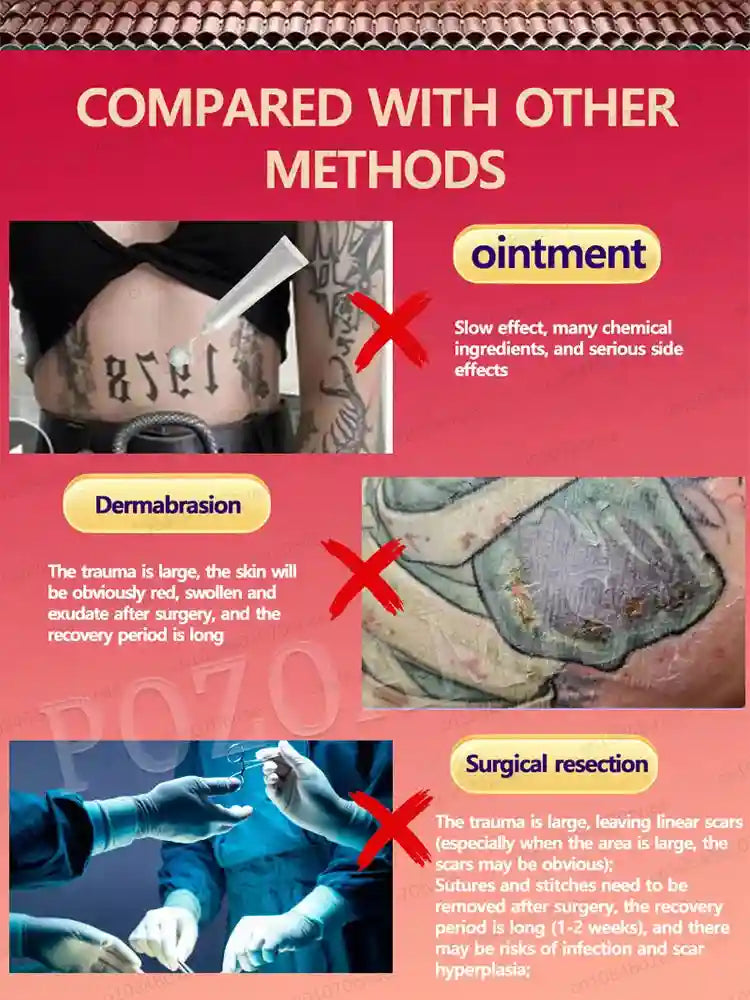 Tattoo Removal Cream - Painless Nano Laser Ink Eraser Treatment Scrubs Treatments Tidesmit