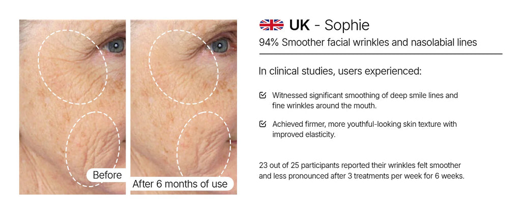 Before and after comparison of facial skin showing reduced wrinkles and smile lines after six months of treatment.
