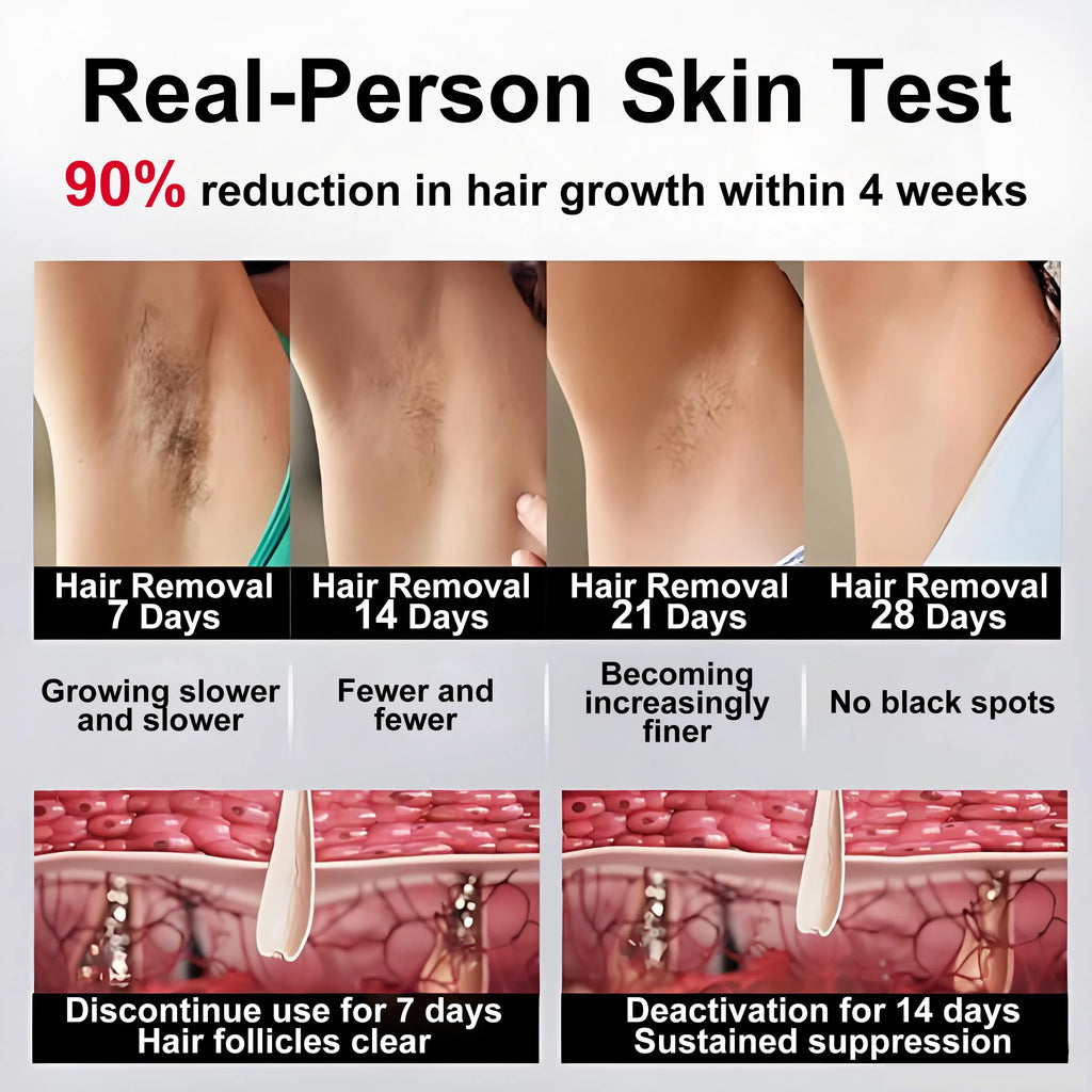 Before-and-after comparison showing underarm hair reduction over 28 days of IPL treatment and follicle deactivation.
