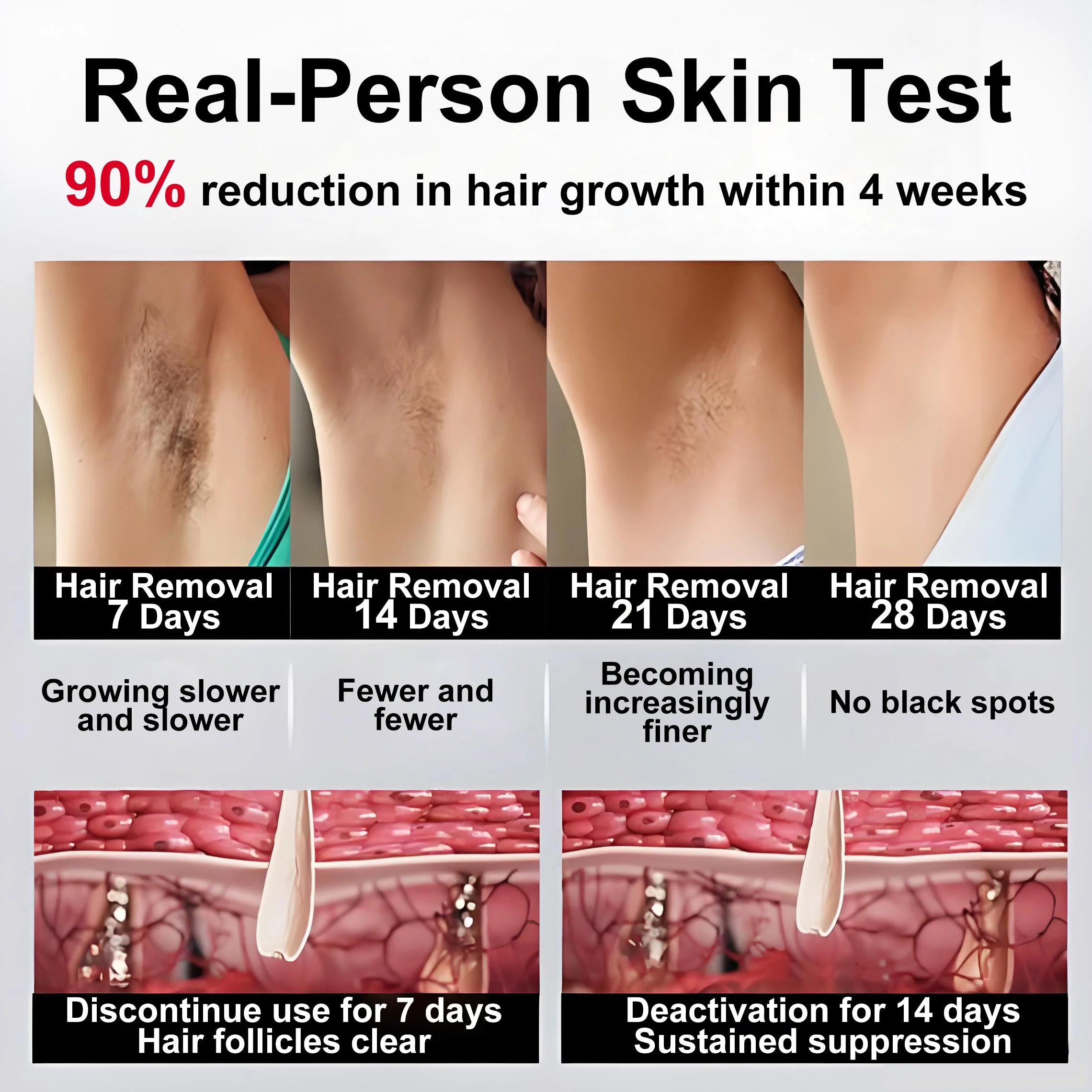 Before-and-after comparison showing underarm hair reduction over 28 days of IPL treatment and follicle deactivation.