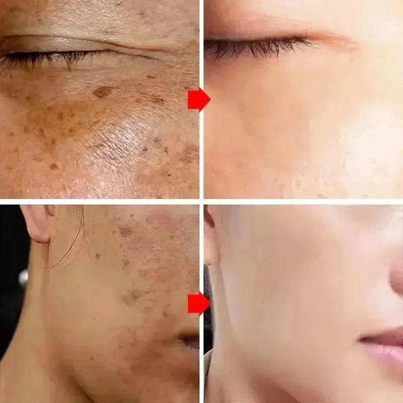 Before and after comparison of skin showing reduction in dark spots, pigmentation, and melasma after cream treatment.