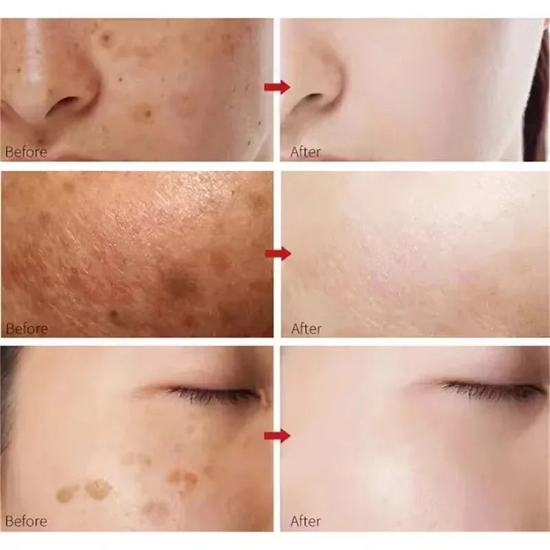 Turmeric Freckle Removing Whitening Essence Fade Pigmentation Melasma Dark Spots Corrector Repair Serum Korean Skin Care