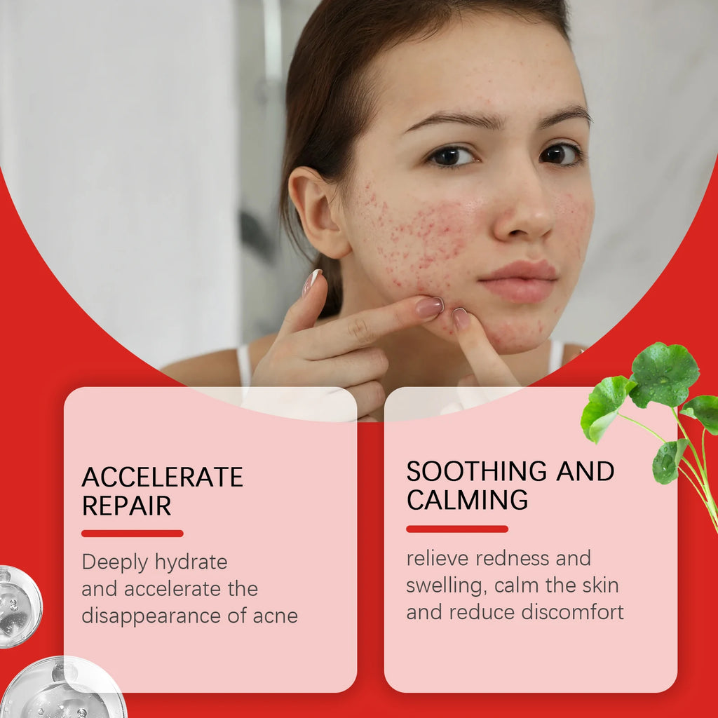 Salicylic Acid Acne Patches 240 Pcs – Shape Assorted Skin Care Scrubs Treatments Tidesmit