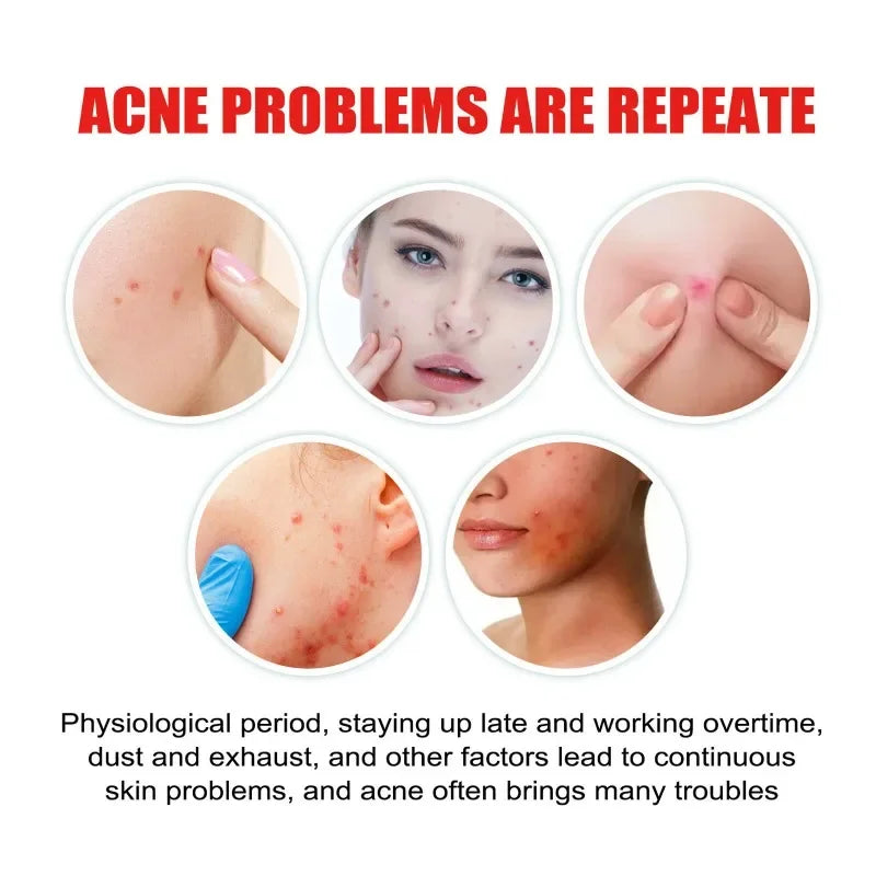 200/400pcs Acne Patches Invisible Pimple Cover for Face Oil Control Spot Treatment Cute Sticker for Covering Zits and Blemishes