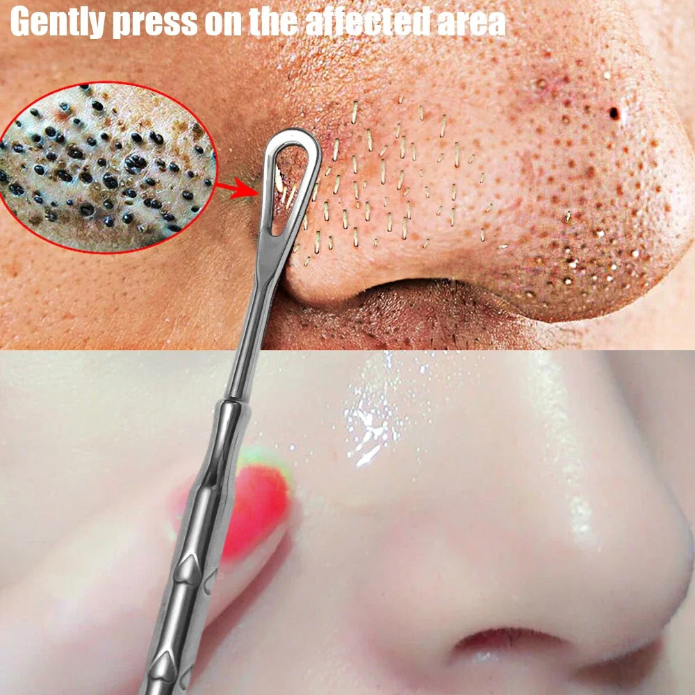 Blackhead Remover Tool Kit 4pc - Professional Stainless Steel Acne Set Scrubs Treatments Tidesmit