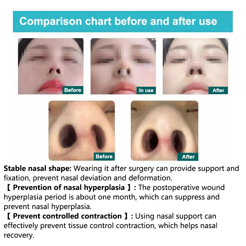 Postoperative silicone rhinoplasty nostril support and nose shaping clip for crooked nose correction and nasal fixation.