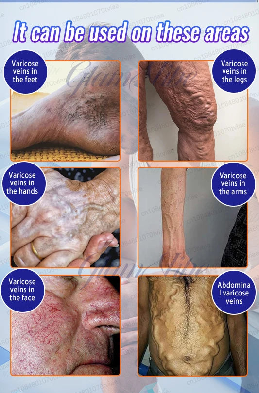 A collage showing human skin affected by varicose veins on the feet, legs, hands, arms, face, and abdomen.