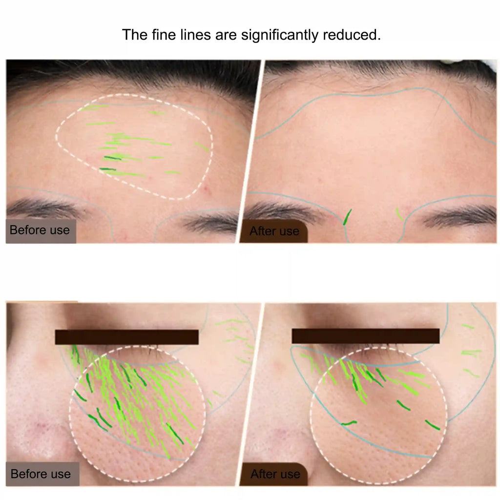 RF Radio Frequency Facial Machine for Skin Tightening - Tidesmit Eye Massage Instrument Tidesmit