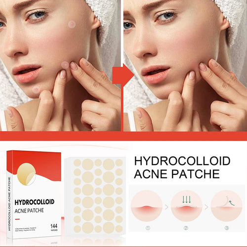 Hydrocolloid acne patch set showing patches applied to the skin near the cheek and jaw