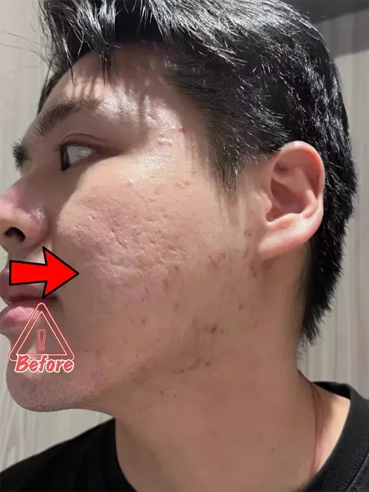 Acne Scar Cream for Face & Pore Fading Treatment | Tidesmit Scrubs Treatments Tidesmit